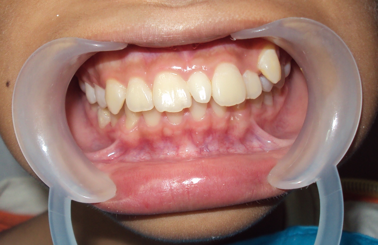 Сверхкомплектный зуб