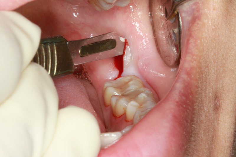 Удаление зуба мудрости на нижней челюсти